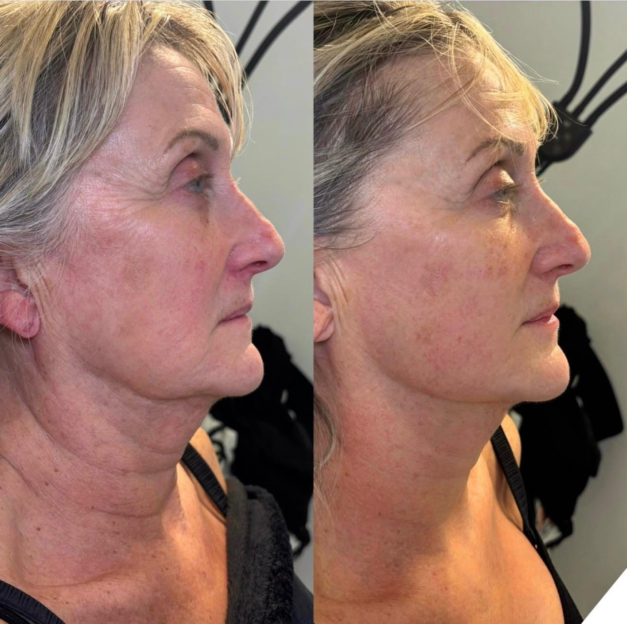 Wrinkles & Fine Lines